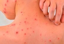 Preocupa alza de muertes por Rickettsia en municipios del sur de Sonora