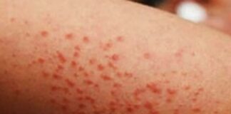 Sarampión se expande por todo México; piden vacunarse