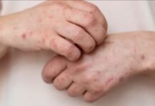 “Es la crónica de una epidemia anunciada”: tres expertos hablan sobre las claves del brote de sarampión en México