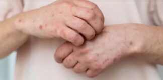 “Es la crónica de una epidemia anunciada”: tres expertos hablan sobre las claves del brote de sarampión en México