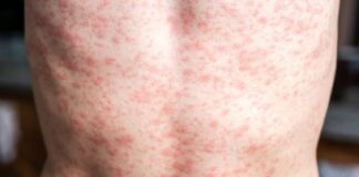 Brote de sarampión en México: Van 28 muertes y CDMX registra su primer deceso