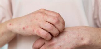 Brote de sarampión en México: Estados con más casos al 11 de febrero de 2026