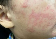 Sarampión supera los 2 mil casos en lo que va de 2026