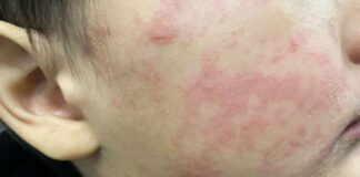 Sarampión supera los 2 mil casos en lo que va de 2026