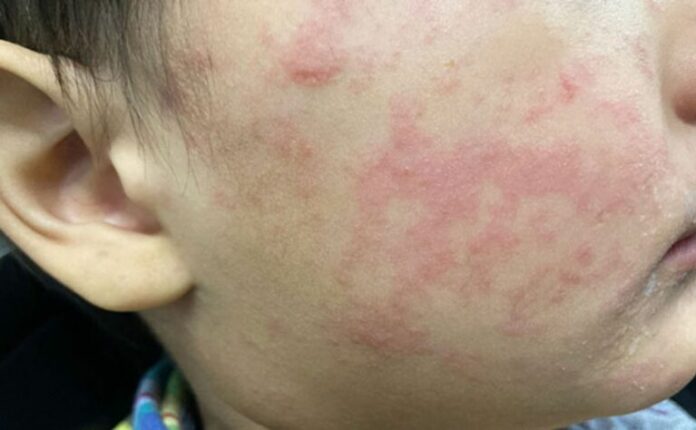 sarampion-en-nino-768x474