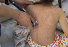 Reportan nueva muerte por sarampión en México