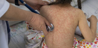 Reportan nueva muerte por sarampión en México